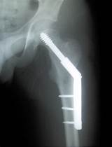 Images of Hip Fracture Surgery Recovery Time