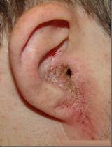 Images of Swimmers Ear Infection Treatment