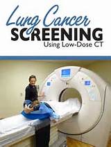 Ct Lung Cancer Screening Medicare
