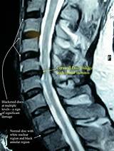 Cervical Spine Disc Bulge Treatment Pictures