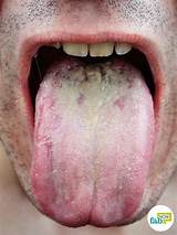 Thrush Mouth Treatment Adults Pictures