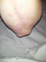 Images of Silver Plaque Psoriasis