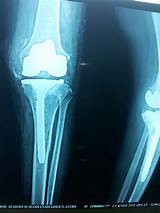 What''s The Recovery Time For A Knee Replacement Images