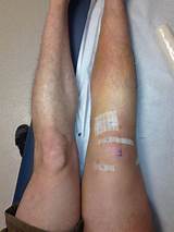 Muscle Atrophy Recovery Images