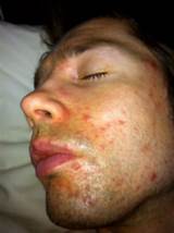 Aggressive Acne Treatment Pictures