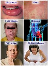 Photos of Side Effects Of Alendronate Fosama