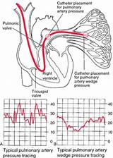 Catheter Definition Medical Images