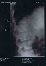 Photos of Fractured T12 Vertebrae Recovery Time
