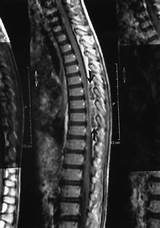 Photos of Spinal Cord Abscess Treatment