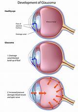 Cataract And Glaucoma Surgery Recovery Time Pictures