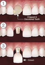 Pictures of Dental Crown Steps