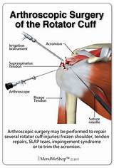 Rotator Cuff Surgery Recovery Exercises