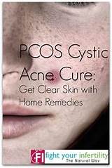 Pcos Acne Home Remedies