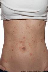 Eczema Treatment During Pregnancy Images