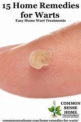 Images of Wart Removal Doctor Cost