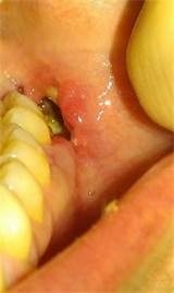Images of Treatment For Dry Socket After Tooth Removal