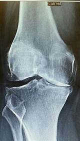 Photos of Recovery From Knee Replacement Surgery Elderly