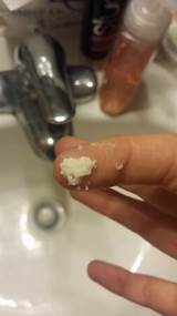 Pictures of Pain After Using Yeast Infection Medication