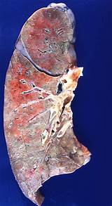 Images of Lung Scarring From Radiation Treatment