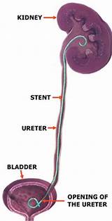 Stint Medical Definition Pictures