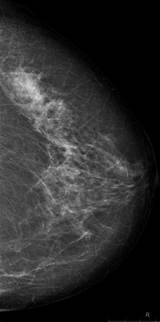Is 3d Mammogram Covered By Insurance