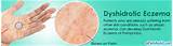 Pictures of Dyshidrotic Eczema Dyshidrotic Dermatitis Home Remedies