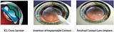 Recovery Time For Cataract Surgery Iol Implant Images