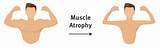 Muscle Atrophy Recovery Images