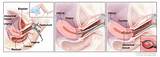 Endometrial Biopsy Recovery
