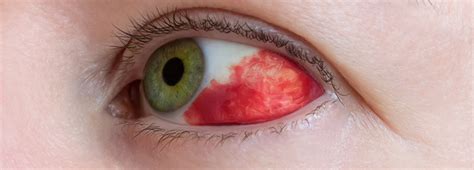 Red Spots Around Eyes After Vomiting Treatment Images