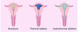 Pictures of Ablation Uterus Recovery