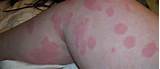 Photos of Severe Allergic Skin Reaction Treatment