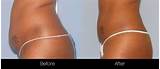 Alternative Liposuction Treatment Pictures