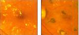 Can Diabetic Retinopathy Be Cured