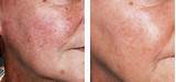 Pictures of Spider Veins On Nose Laser Treatment