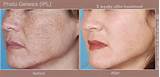 Images of Dark Spot Removal Laser Treatment