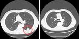 Photos of Ct Lung Cancer Screening Medicare