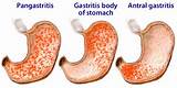 Acute Gastritis Home Remedies Images