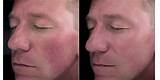 Images of Laser Treatments For Rosacea On Face