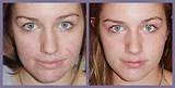 Pictures of Best Natural Acne Scar Treatment