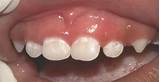 Pictures of Silver Treatment For Cavities