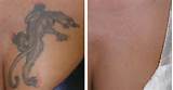Images of Laser Dark Spot Removal Nyc
