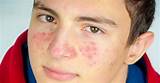 Acne Doctor Images