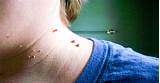 What Doctor Removes Skin Tags Images