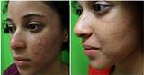 Laser Treatment For Acne Scars On Black Skin