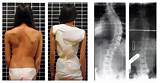 Images of Exercises Scoliosis