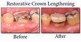 Clinical Crown Lengthening