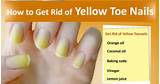 Home Remedies Yellow Toenails Pictures