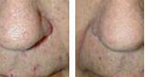 Spider Vein Treatment Before And After Photos