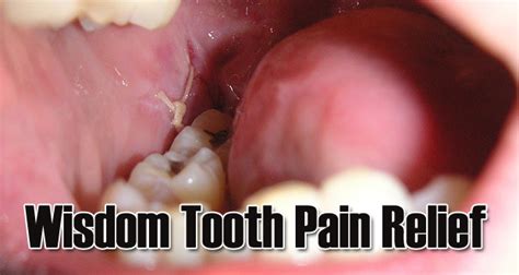 What Can I Take For Wisdom Tooth Pain Photos